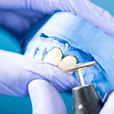 Aufnahme einer Zahnmodellage 2